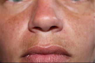 פיגמנטציה באזור השפם: למה זה קורה?