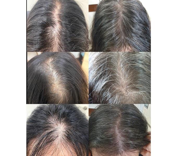 אישה לפני ואחרי השתלת שיער 