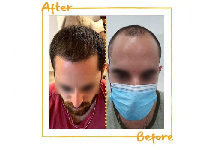 לפני ואחרי השתלת שיער