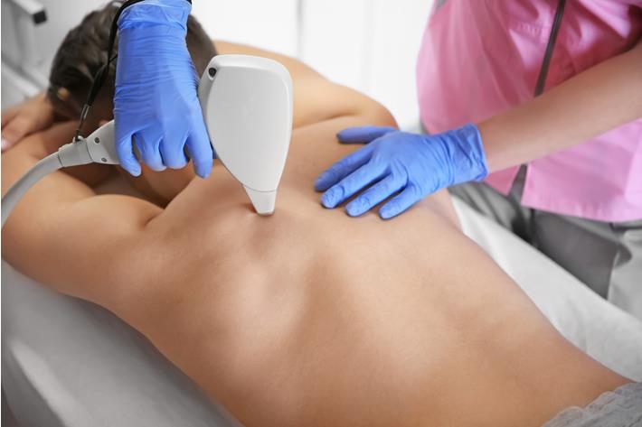 גבר עובר טיפול להסרת שיער בלייזר באזור הגב 