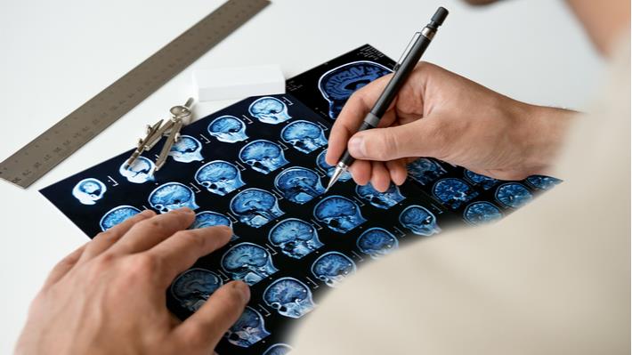 ניורולוג בוחן בדיקת MRI של חולה בטרשת נפוצה 