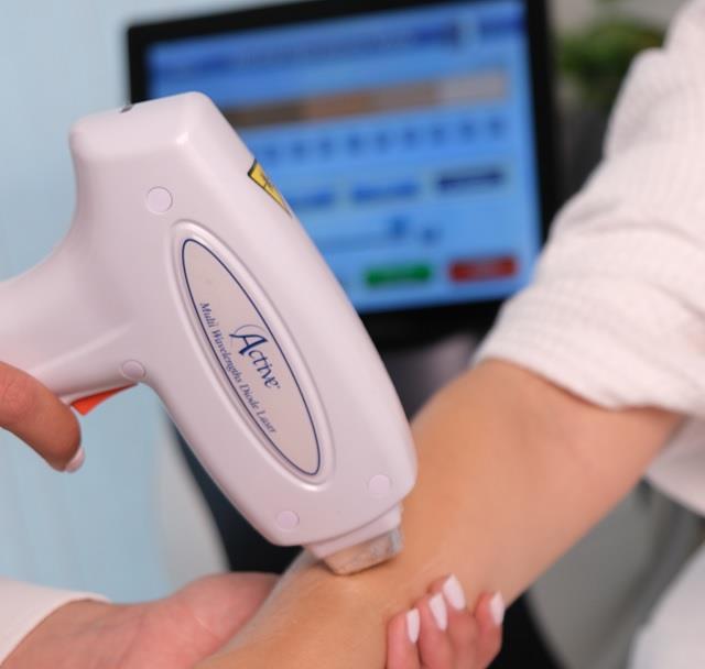 הסרת שיער בלייזר