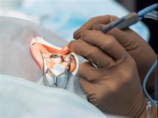  כל מה שחשוב לדעת על ניתוחי קטרקט