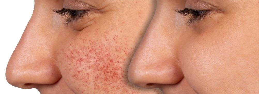 איך להרגיע אלרגיה בפנים: המדריך המלא לטיפול מידי