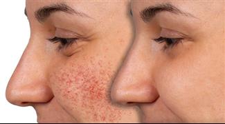 איך להרגיע אלרגיה בפנים: המדריך המלא לטיפול מידי