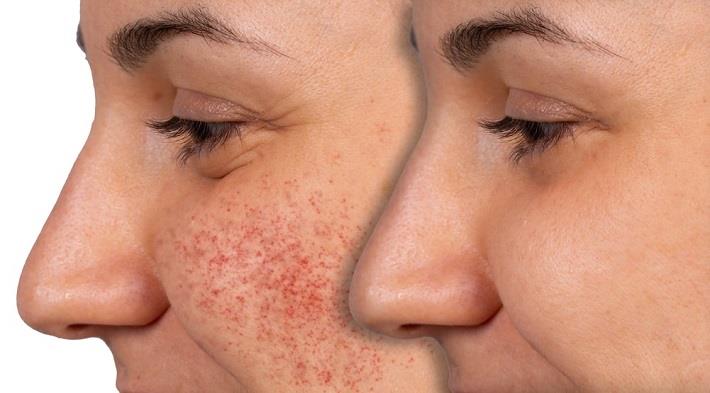 פרופיל אישה עם פנים חלקות ועם אלרגיה בפנים