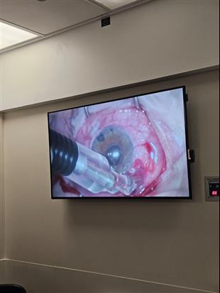 ציקלופוטוקואגולציה בלייזר (CPC) - הטיפול האפקטיבי לחולי גלאוקומה מורכבים: עכשיו גם במסגרת הפרטית