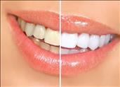 הלבנות שיניים - כיצד הן מתבצעות