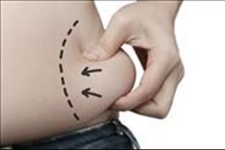 ניתוח שאיבת שומן - להסיר את השומן במקומות שפעילות גופנית לא עוזרת