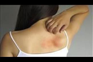 אלרגיה - כיצד מטפלים באלרגיות