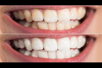 הלבנת שיניים ביתית: כך תשמרו על שיניים לבנות