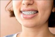 הקשר בין יישור שיניים לאפקט הפרפר