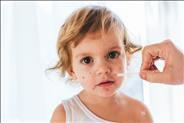 אבעבועות רוח תינוקות וילדים - טיפול