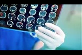 טרשת עורקים גורמת ל- % 50 מכלל המקרים של שבץ מוחי