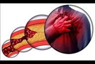 טרשת עורקים: החיים בצל המחלה