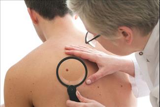 סרטן העור: מתי צריך להיבדק אצל רופא