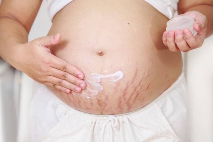 אישה בשבוע 27 להריון מורחת קרם על סימני המתיחה בבטן