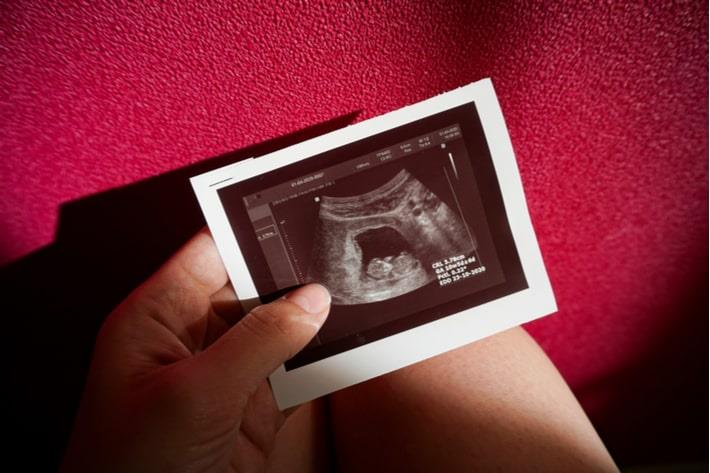 צילום אולטרסאונד על בטן של אישה בשבוע 10 להריון