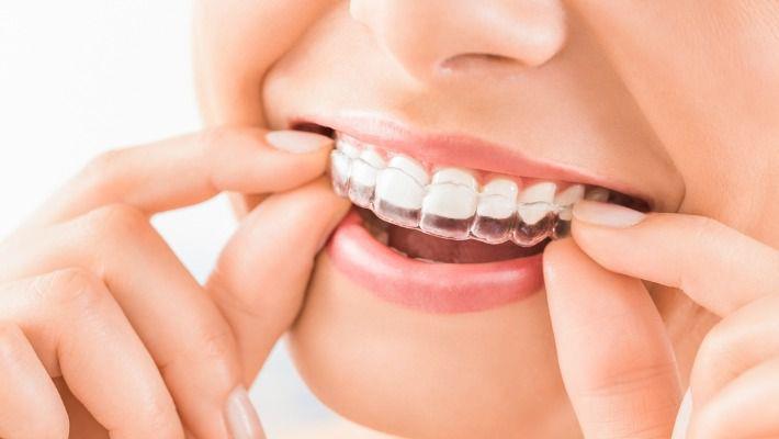 אישה מחייכת ומרכיבה על שינייה קשתיות שקופות ליישור שיניים