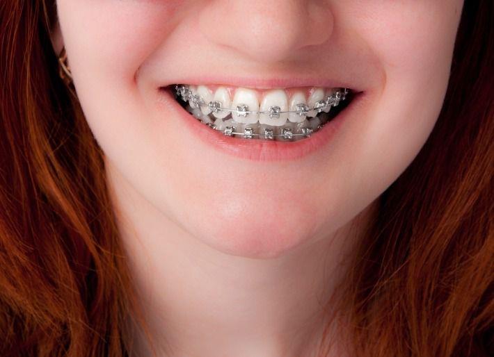 נערה מחייכת עם סמכים (קוביות) בשיניים לצורך יישור שיניים