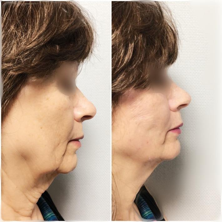 תמונת לפני ואחרי טיפול באמצעות חוטי אפטוס