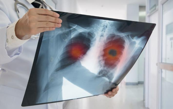 רופא בוחן צילום סיטי ריאות של אדם החולה בסרטן ריאות 