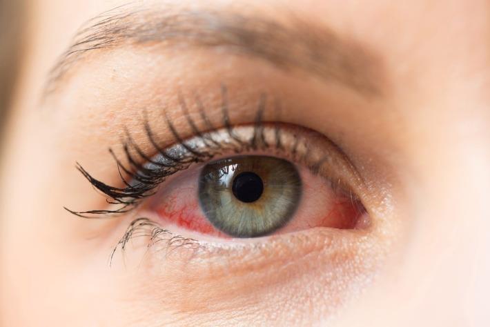 אישה סובלת מאדמומיות בעיניים בגלל יובש בעיניים