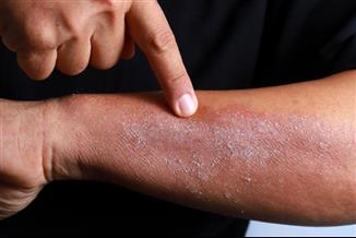 הטיפולים הכי עדכניים לאטופיק דרמטיטיס