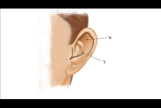 איך לטפל באוזניים בולטות?
