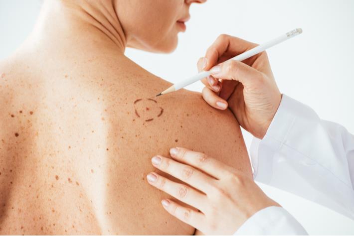 אישה עוברת בדיקת שומות כדי לשלול את שלושת הסוגים הנפוצים של סרטן העור 