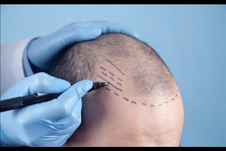 השתלת שיער: 6 שאלות שכדאי לשאול - והתשובות