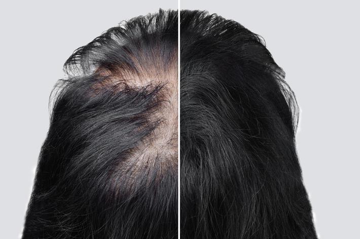 אישה לפני ואחרי השתלת שיער