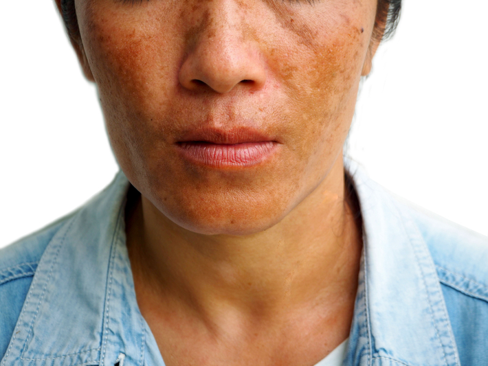 אישה סובלת מהיפרפיגמנטציה בשפם ובלחיים 