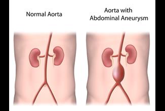 מפרצת באבי העורקים הבטני: האם קיימת דרך למנוע את סיבוכי המחלה הקטלנית?