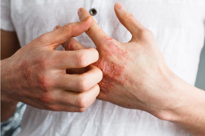 אדם סובל מעור יבש בידיים 