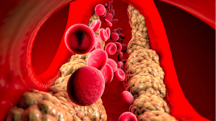 אילוסטרציה של הצטברות שומן וטריגליצרידים בזרם הדם