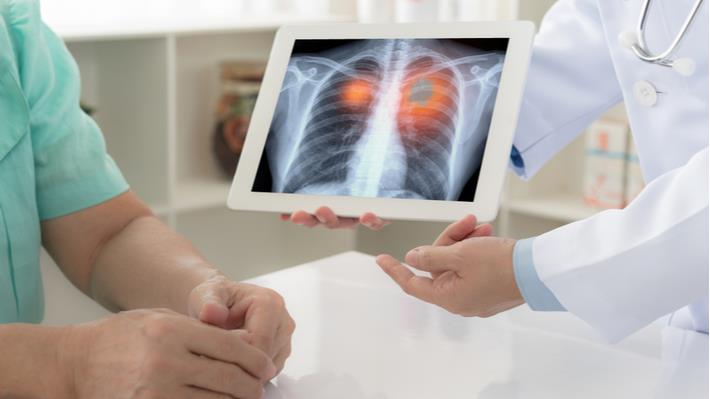 אונקולוג מסביר למטופל על אבחון וטיפול בסרטן הריאות 