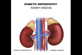 חולי סוכרת? אתם מצויים בסיכון למחלת כליות כרונית