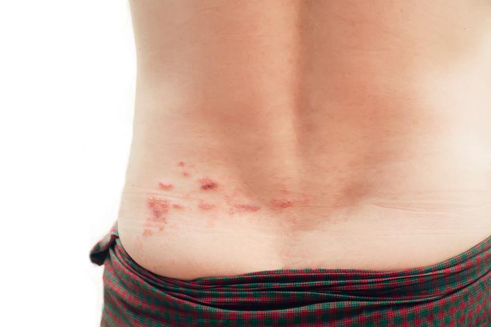 Bare back of a man with shingles on one side