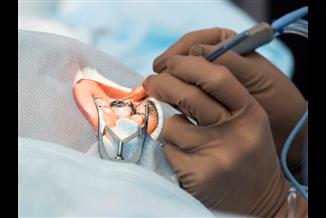 כל מה שחשוב לדעת על ניתוחי קטרקט