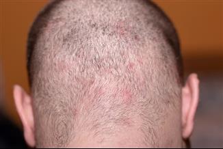 פצעים בקרקפת: המדריך המקיף לזיהוי וטיפול