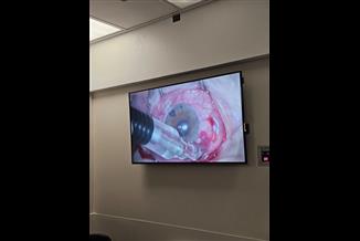 ציקלופוטוקואגולציה בלייזר (CPC) - הטיפול האפקטיבי לחולי גלאוקומה מורכבים: עכשיו גם במסגרת הפרטית