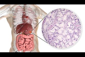 הסרת גידולים במערכת העיכול באמצעות הליך ה-ESD : המדריך המלא