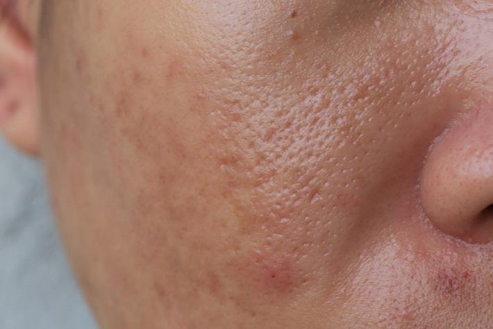 תקריב של עור הפנים באמצעותו ניתן לראות נקבוביות