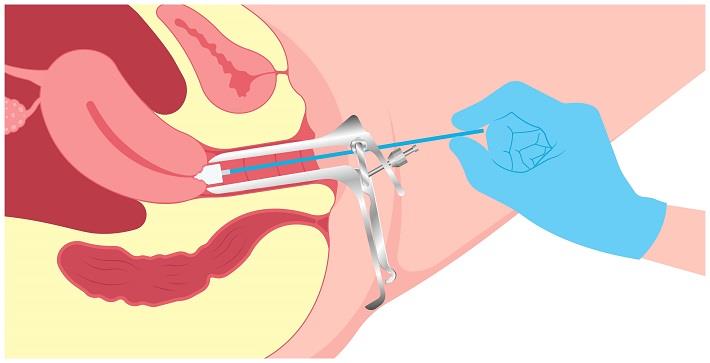 איור המדגים בדיקת פאפ, בדיקת ציטולוגיה