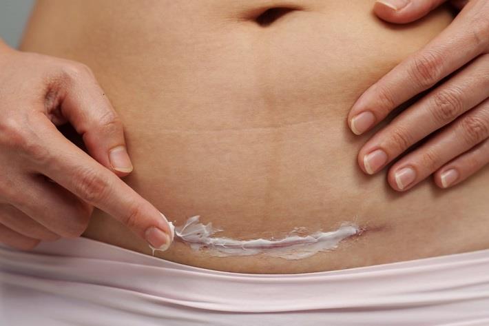 אישה מורחת קרם על בטן עם צלקת