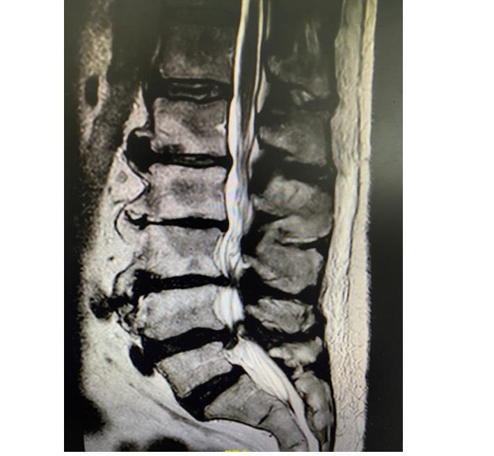הדמייה של היצרות תעלת עמוד השדרה