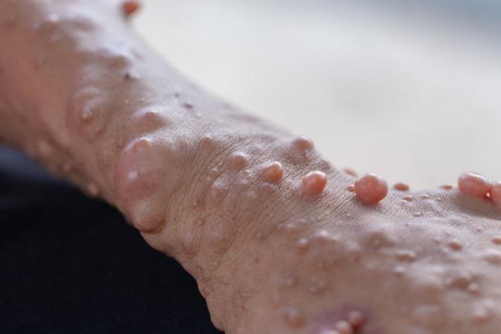 יד עם נגעים של נוירופיברומטוזיס