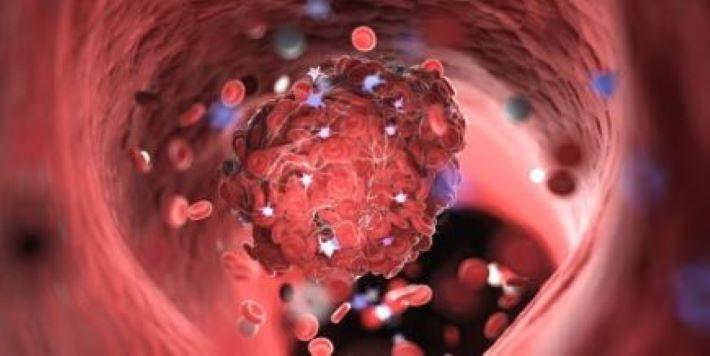 הדמיה של קריש דם, אנאגרליד לטיפול בתרומבוציתמיה ראשונית