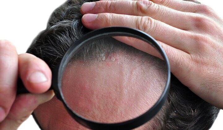 פטריה, קשקשים, סבוריאה, אגיספור, קומאגיס, ביפונאזול